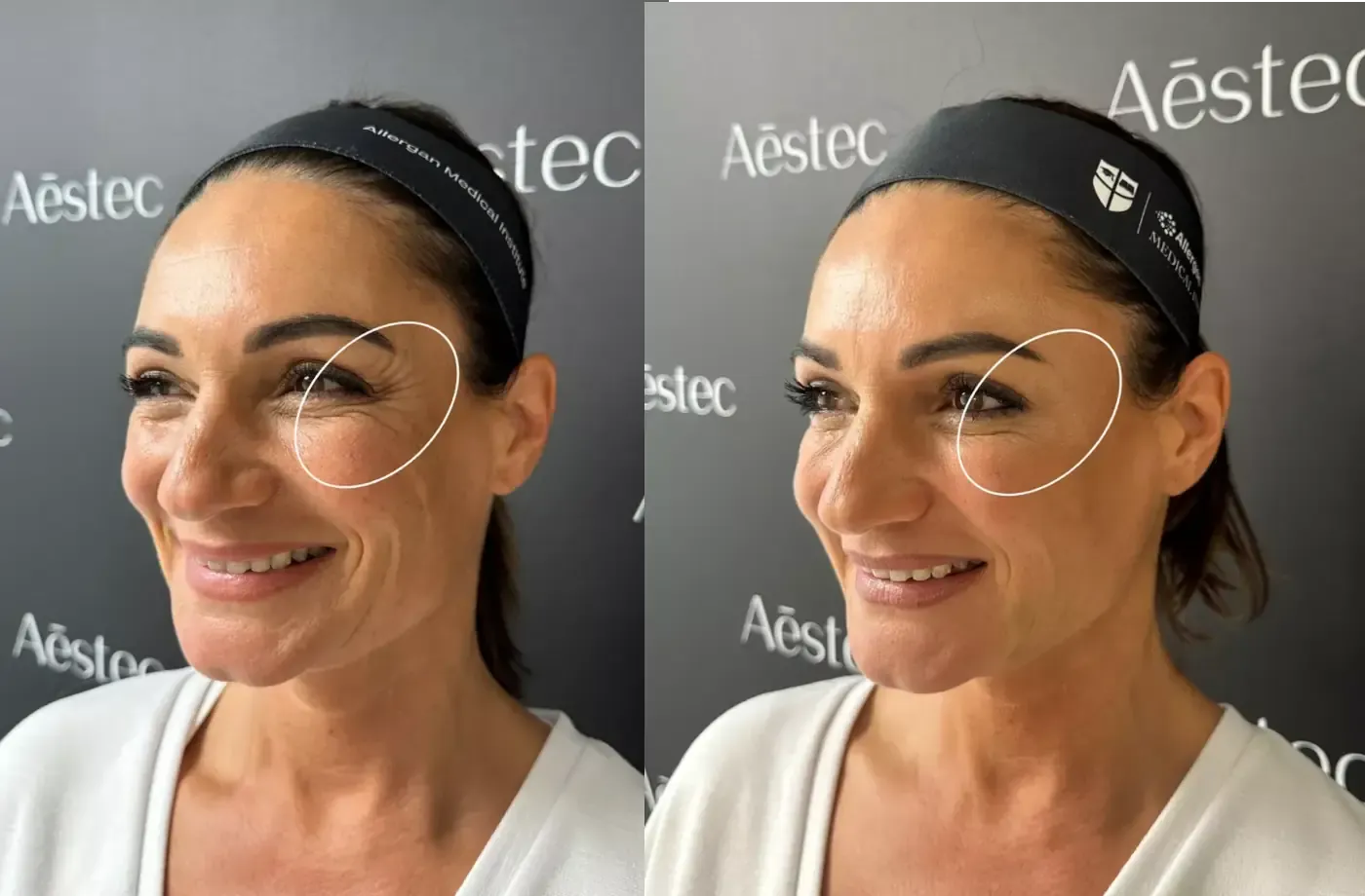 Lien — voor en na botox