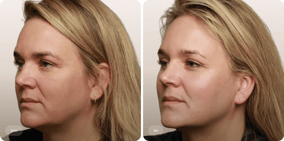 Charlotte — voor en na fillers
