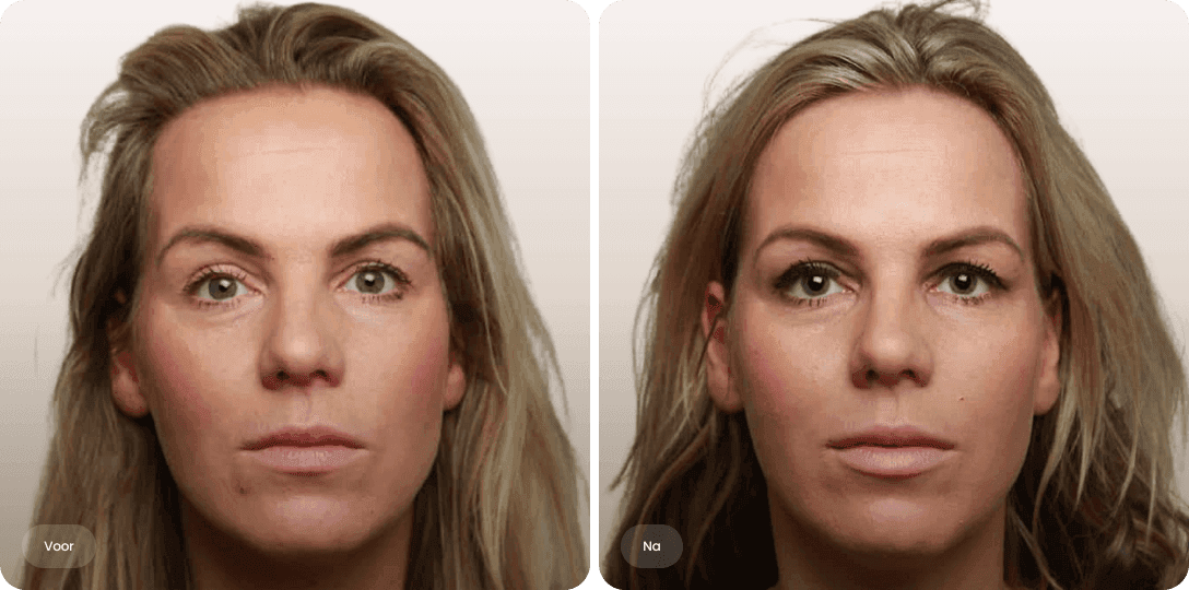 Nathalie — voor en na fillers