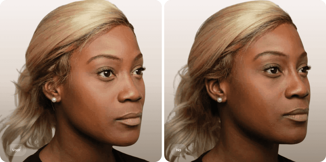 Marie — voor en na fillers