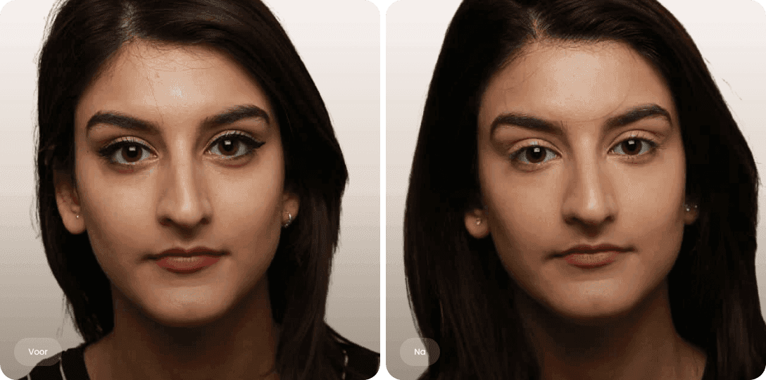 Sofie — voor en na fillers